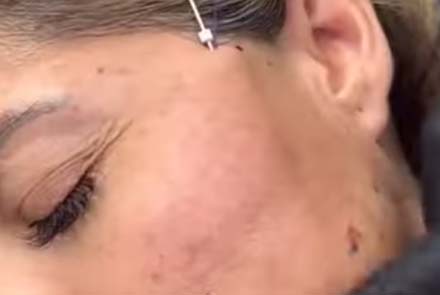 Watch Flawless Scalp Therapy Video