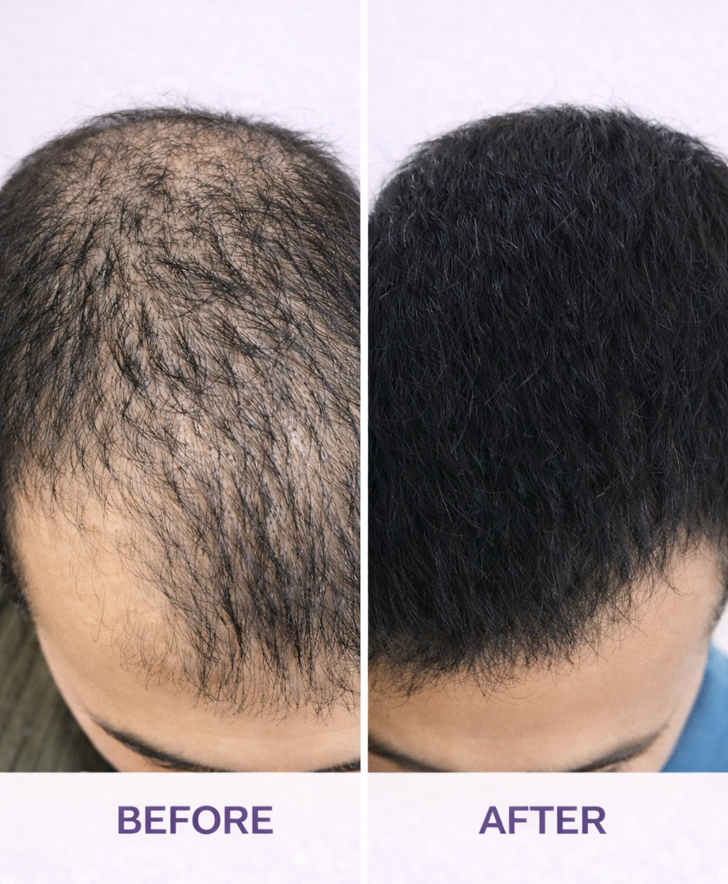 Nutritional Hair Loss Treatment